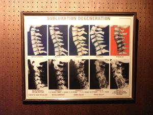 SUBLUXATION DEGENERATION picture